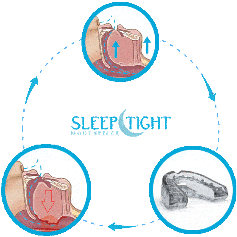 SleepTight Mouthpiece Review